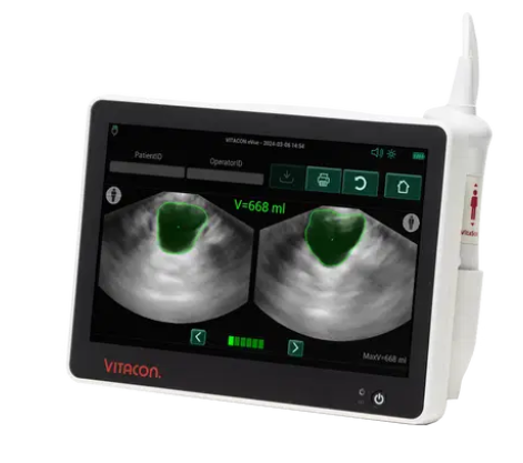Screen of Vitacon Vitascan eVue Portable Bladder Scanner showing bladder scan results